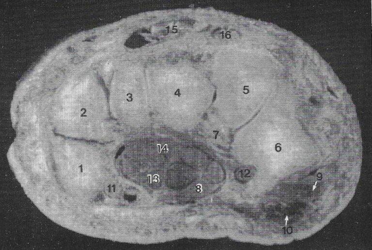 Pustractic Hand Plastination of the Wrist: Potential Uses in Education and Clinical ...